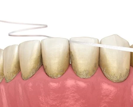 Dental floss cleaning process. Medically accurate dental Stock Illustration