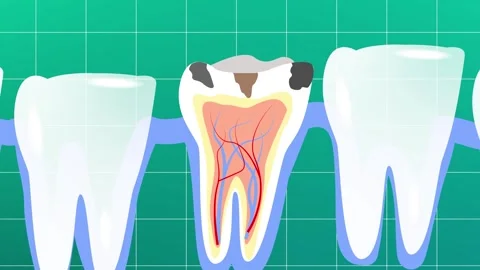 Dental Health animated Techniques for Pulling Out tooth decay Stock Footage 302880348