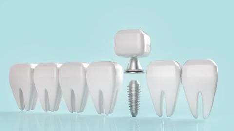 Dental implant 3d rendering image for medical content.. Stock Illustration