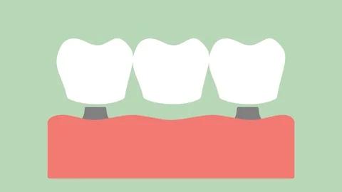Dental implant with bridge, installation process and change of teeth Stock Footage 105338024