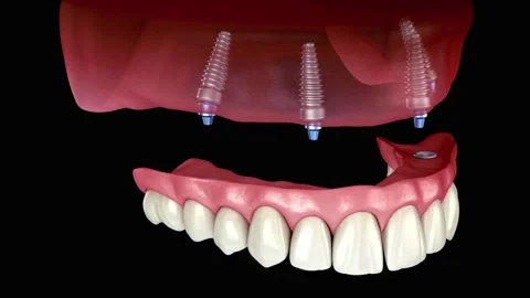 Dental Implant Bridge Supported by Multiple Implants Stock Footage 327664589