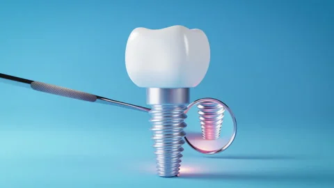 Dental implant Stock Footage 271018332