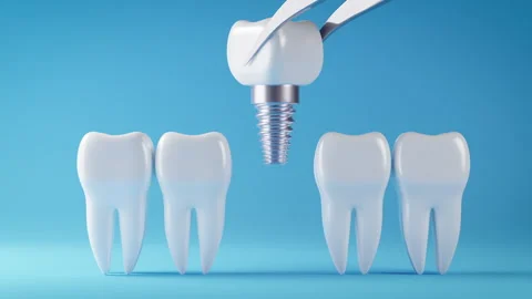 Dental implant Stock Footage 271018333