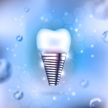 Dental implant Stock Illustration