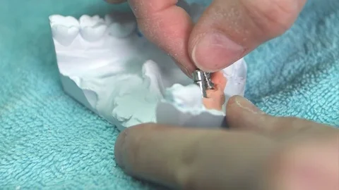 Dental implant is inserted into a jaw bone 動画素材 80079570