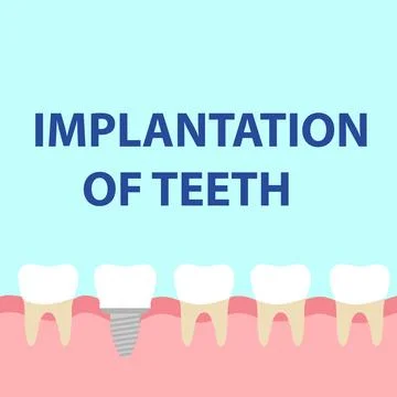 Dental implant model 스톡 일러스트