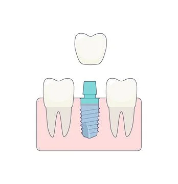 A dental implant placed between two healthy teeth, the abutment is covered with Stock-Illustration