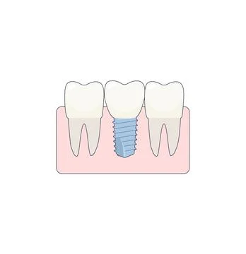 A dental implant placed between two healthy teeth, the abutment is covered with Stock Illustration