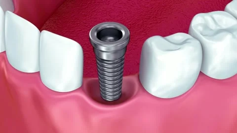 Dental Implant Placement Process Shown in Animation Stock Footage 327669784