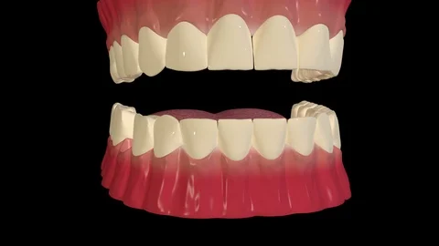 Dental Implant Procedure 스톡 동영상 127344943