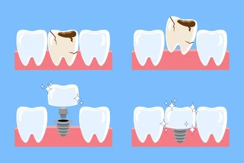 Dental implant procedure installation . Decayed tooth removed and replace b.. Stock Illustration