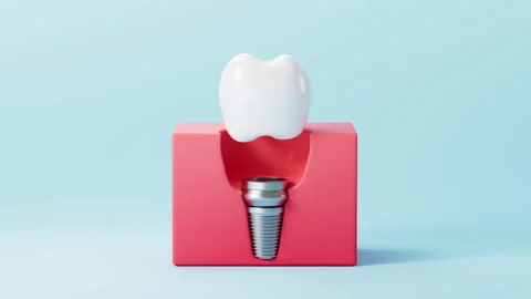 Dental implant surgery process. A concept of implantation teeth and dental .. Stock Footage 336144482