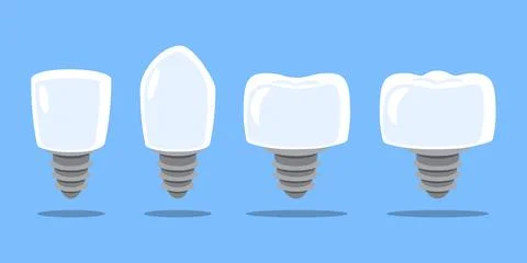 Dental implant . Type of teeth include incisor, canine, premolar and molar .. Stock Illustration