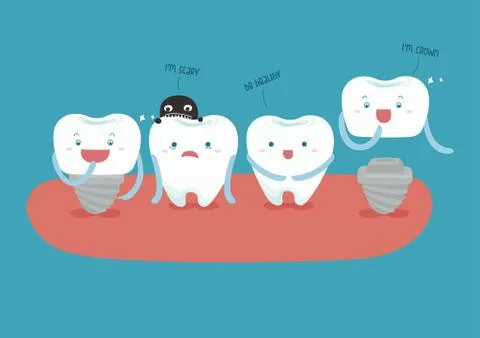 Dental implant vector Stock Illustration