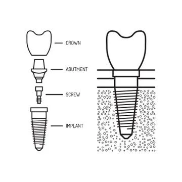 Dental implant vector Stock Illustration