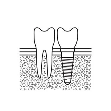 Dental implant vector Stock Illustration
