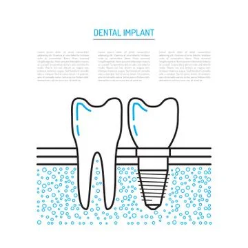 Dental implant vector Stock Illustration