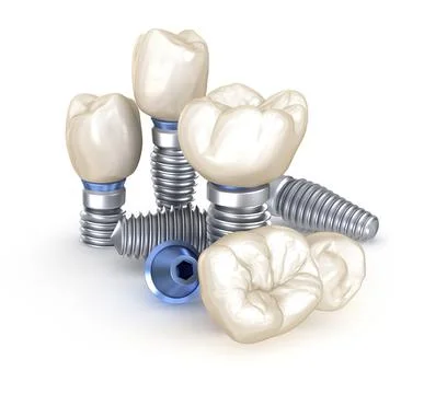 Dental Implants. 3D illustration concept of human teeth Stock Illustration