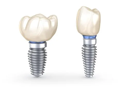 Dental Implants. 3D illustration concept of human teeth Stock Illustration