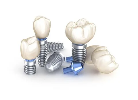 Dental Implants. 3D illustration concept of human teeth Stock Illustration