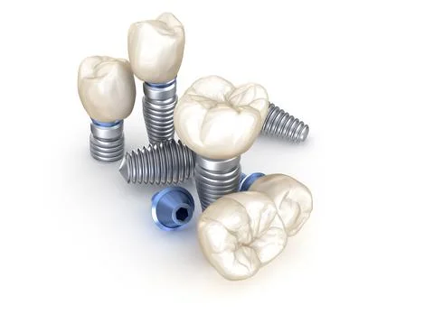 Dental Implants. 3D illustration concept of human teeth Stock Illustration