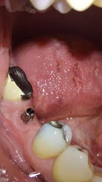 Dental Implants Close-Up: Titanium Post in Gum, Medical Detail Focus Stock Photos