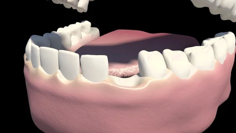 Dental Implants Stock Footage 121535671
