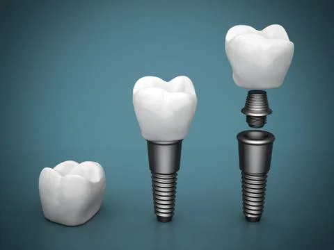 Dental implants Stock Illustration
