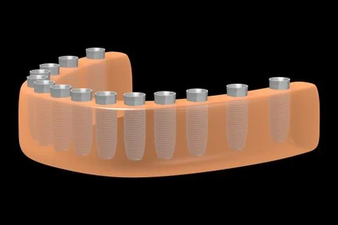 Dental implants/ teeth implants Illustrazione stock