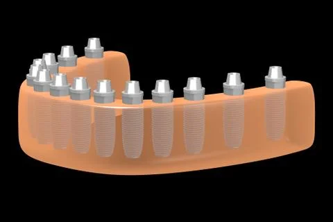 Dental implants/ teeth implants Illustrazione stock