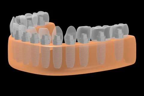 Dental implants/ teeth implants Illustrazione stock
