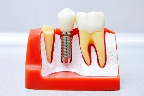 Dental implants, tooth implants Stock Photos