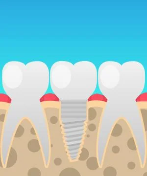 Dental implants, tooth replacement, vector illustration in a cartoon flat style Stock Illustration