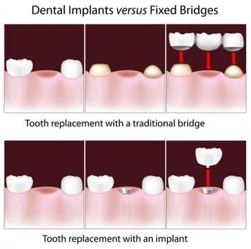 Dental implants versus fixed bridges 스톡 일러스트