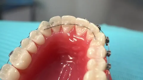 Dental Model with Braces Stock Footage 314521004