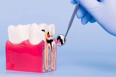 Dental model displaying tooth structure and cavity, examined with a dental mi Stock Photos