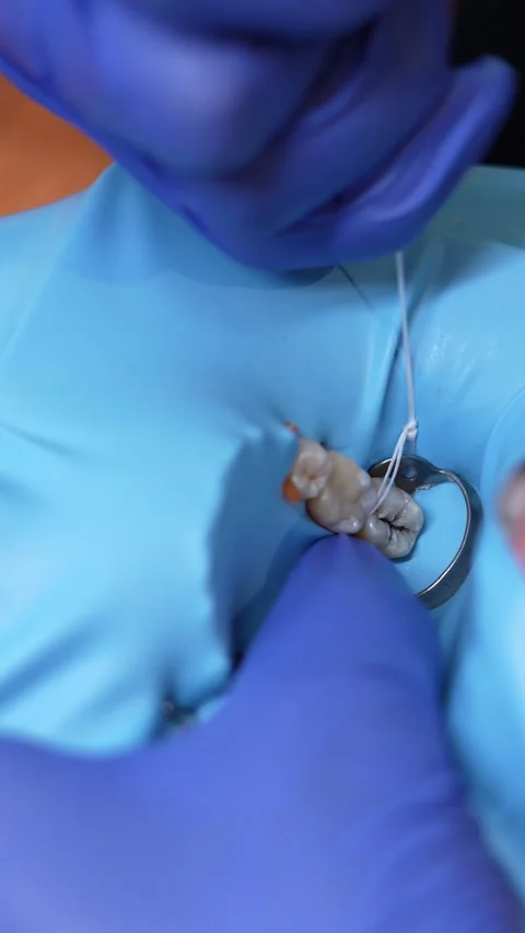 Dental Operation Close-Up Stock Footage 316915458