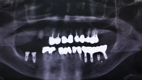 Dental Panoramic of a Dental Implants Surgery Patient, Close Up of the Implants Stock Footage 103588903