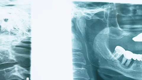 Dental panoramic X-ray scan showing teeth structure and dental implants clo.. Vídeos de archivo 340632874