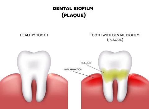 Dental plaque Stock Illustration