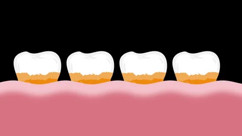 Dental plaque on molar teeth Stock Footage 309451614