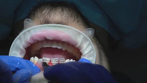 Dental Procedure in Action Stock Footage 316913408