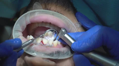 Dental Procedure in Action Stock Footage 316914200