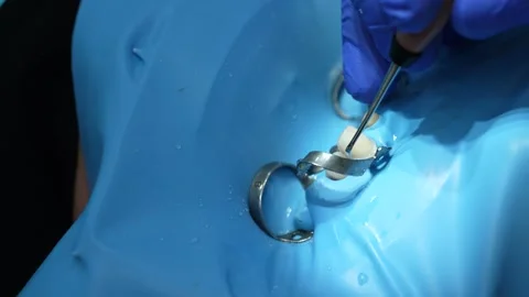 Dental Procedure in Action Stock Footage 316914252