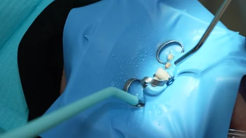 Dental Procedure in Action Stock Footage 316914301
