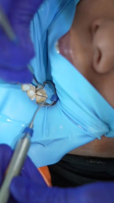 Dental Procedure in Action Stock Footage 316914486