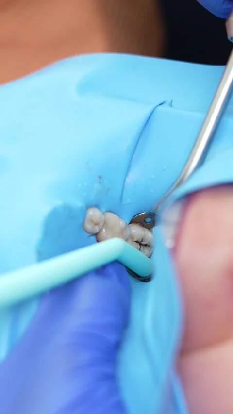 Dental Procedure in Action Stock Footage 316914760