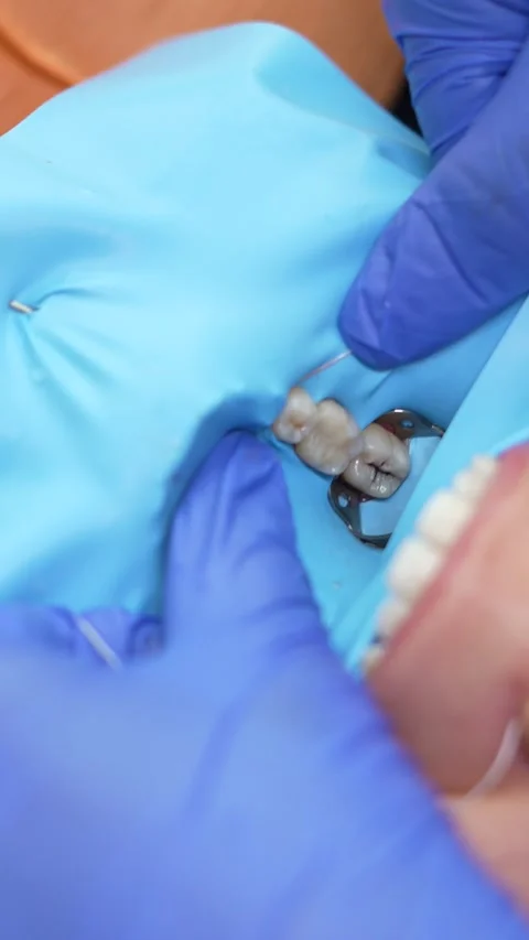 Dental Procedure in Action Stock Footage 316914805