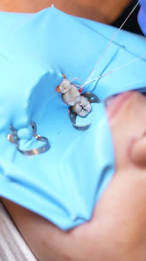 Dental Procedure in Action Stock Footage 316915185