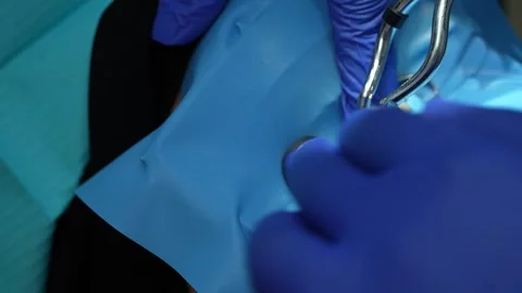 Dental Procedure in Action Stock Footage 316916278